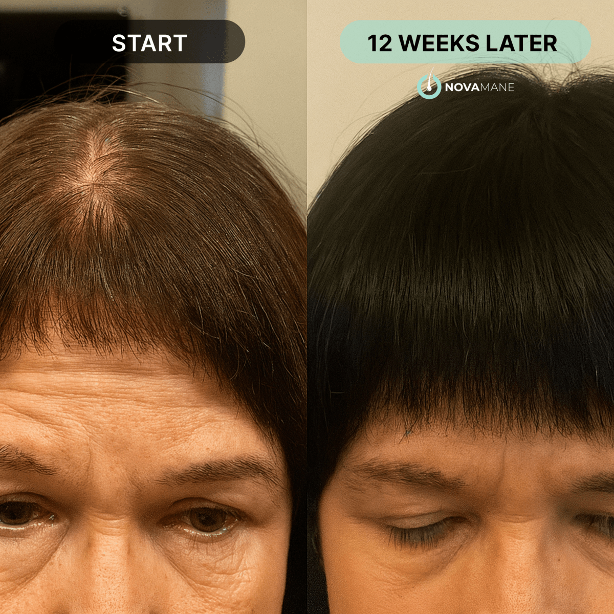 NovaMane™ Hair Regrowth 2.0