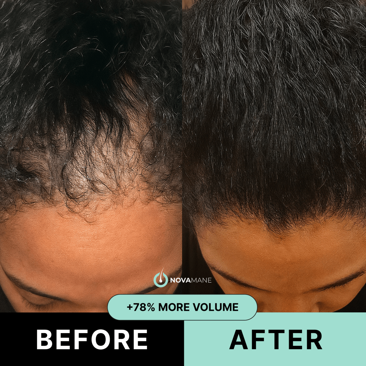 NovaMane™ Hair Regrowth 2.0